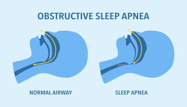 Απνοια, Αντιμετώπιση Διαταραχή Υπνου